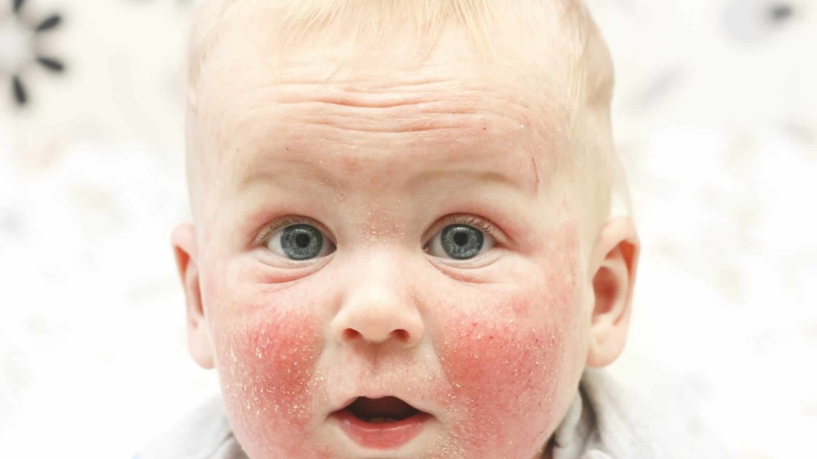 dia-mundial-de-la-dermatitis-atopica-1-scaled